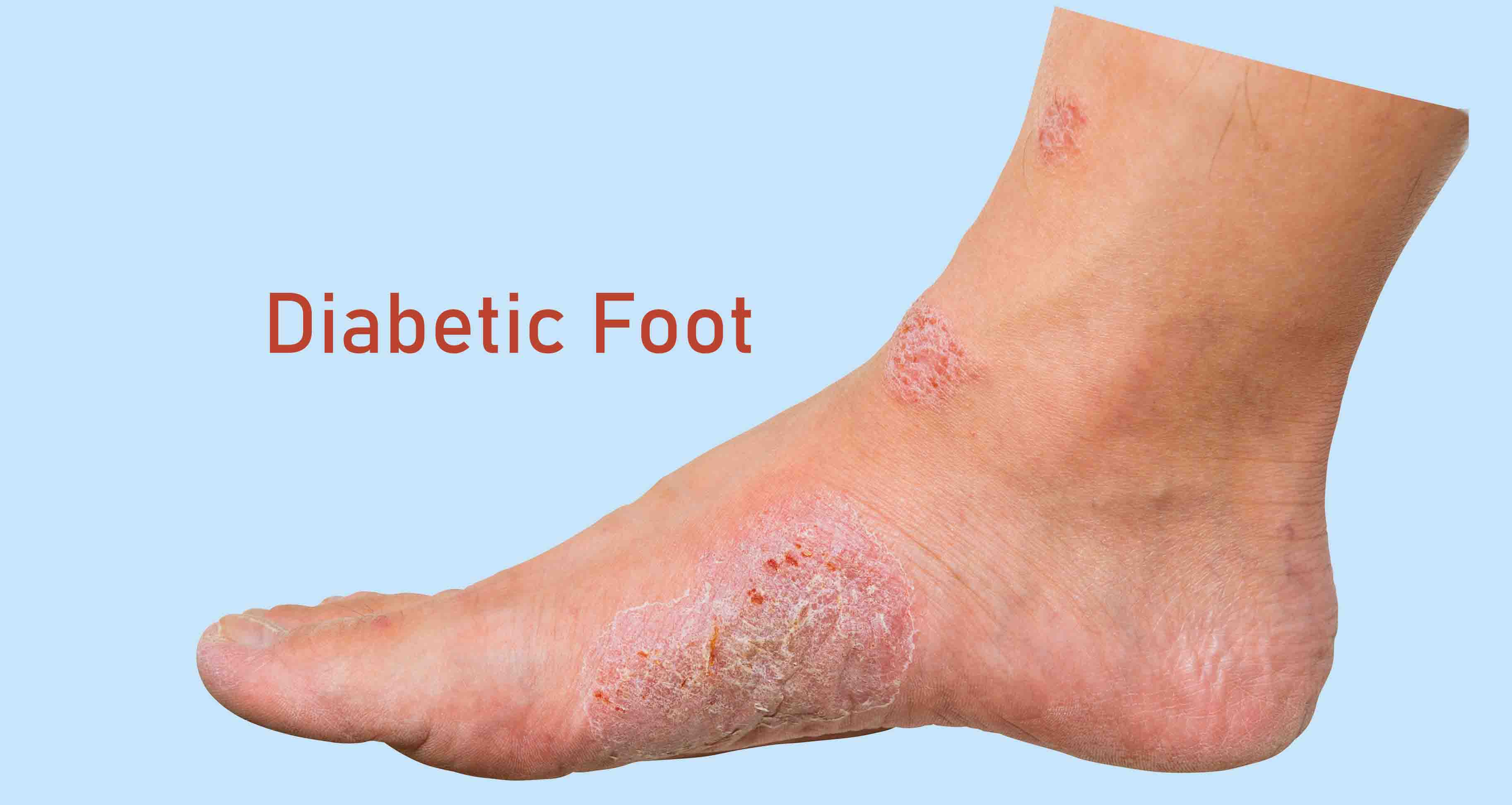 Diabetic Foot Ulcers & its Management - Dr. Sanjay Sharma | Doctors' Circle  - YouTube