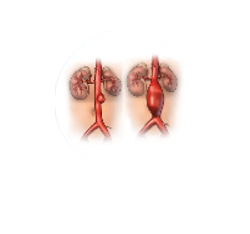 Aortic Aneurysm